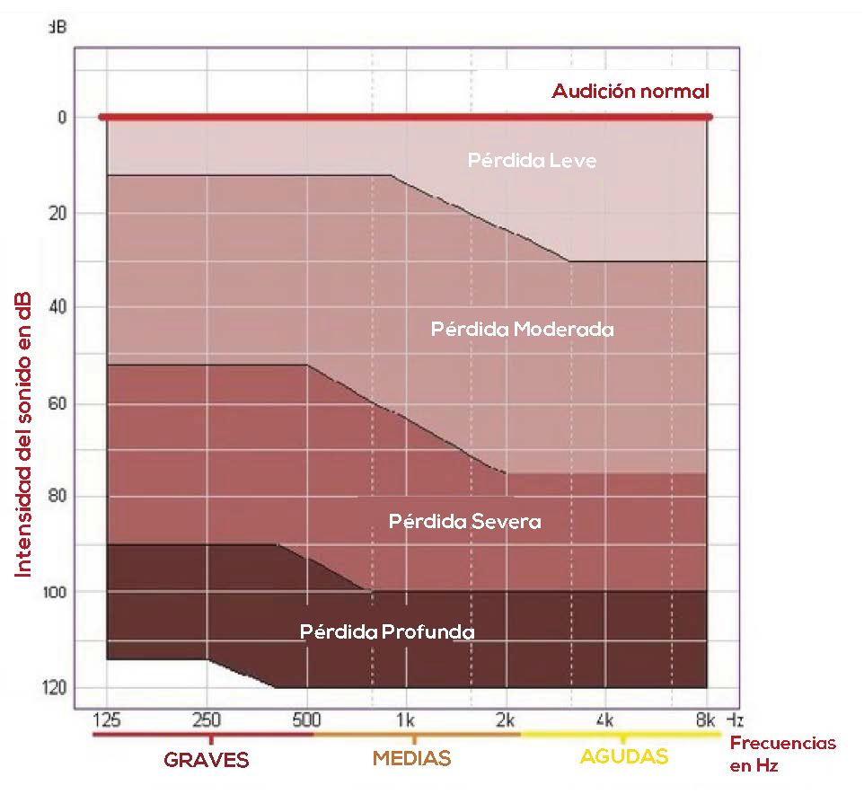 Perte auditive selon les degrés de surdité  